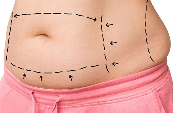 Abdominoplasty